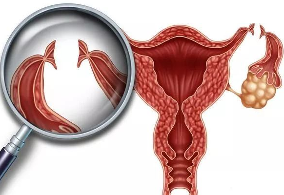 深圳女性卵巢囊腫有哪些需要注意的