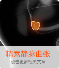 精索靜脈曲張